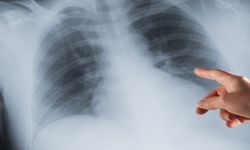 Akciğer kanserinde erken teşhis hayat kurtarıyor!
