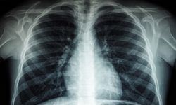 Eskişehir'de uzmanından uyarı: Akciğer sağlığına dikkat!