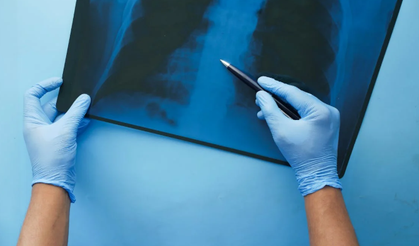 Akciğer kanserinde erken tanı hayat kurtarıyor