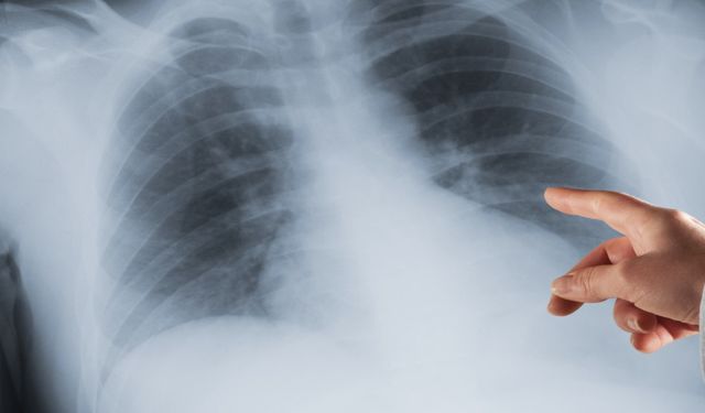 Akciğer kanserinde erken teşhis hayat kurtarıyor!