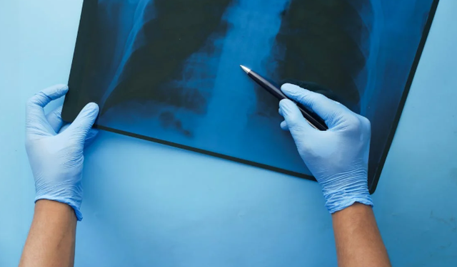 Akciğer kanserinde erken tanı hayat kurtarıyor