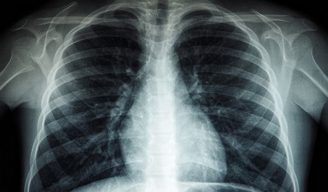 Eskişehir'de uzmanından uyarı: Akciğer sağlığına dikkat!