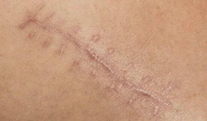 Ameliyat sonrası izler neden oluşur? Uzmanından önemli uyarılar